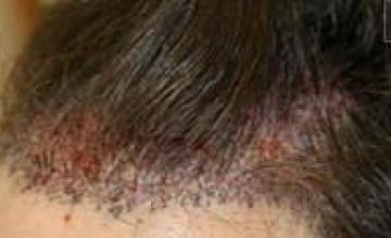 Before and after hair transplant left view images