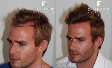 Hair transplantation surgery before and after images