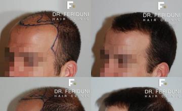 Before and after surgical hair restoration images