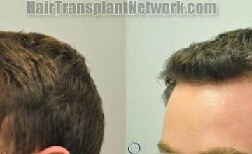 Hair transplantation surgery before and after pictures