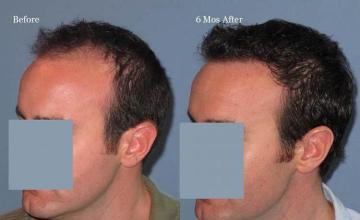 Hair transplantation surgery before and after images