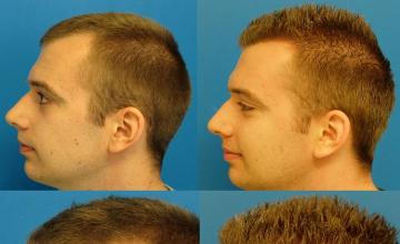 Hair transplantation surgery before and after pictures