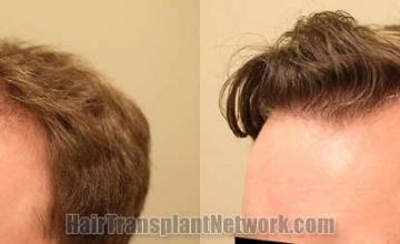 Hair restoration surgical procedure before and after pictures