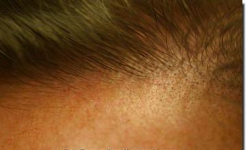 Hair restoration procedure results