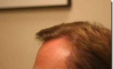 Hair restoration procedure results