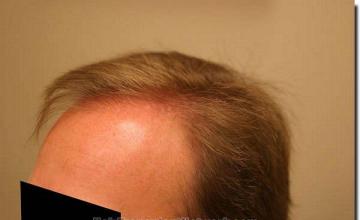 Hair restoration procedure results