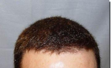 Hair restoration procedure results