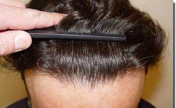 Hair restoration procedure results