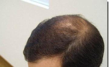 Hair restoration procedure results