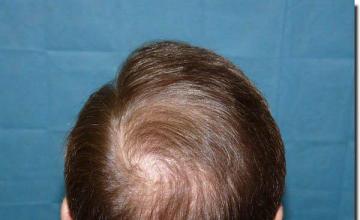 Hair restoration procedure results