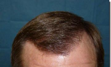 Hair restoration procedure results