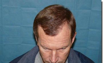 Hair restoration procedure results