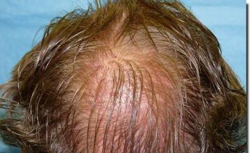 Hair restoration procedure results