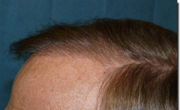 Hair restoration procedure results