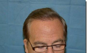 Hair restoration procedure results