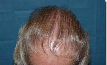 Hair restoration procedure results