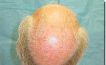 Hair restoration procedure results