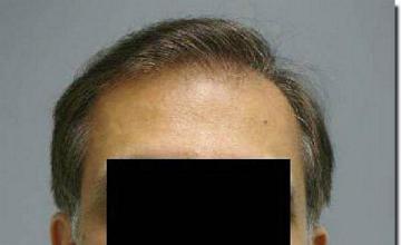 Hair restoration procedure results