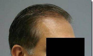 Hair restoration procedure results