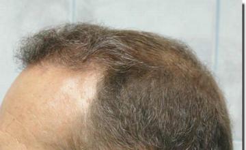 Hair restoration procedure results