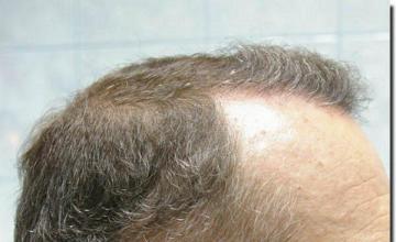 Hair restoration procedure results