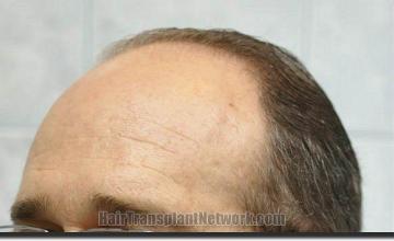 Hair restoration procedure results