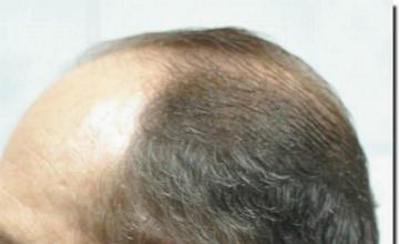 Hair restoration procedure results