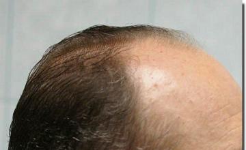 Hair restoration procedure results