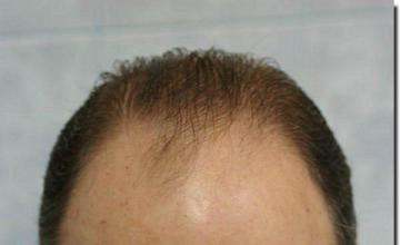 Hair restoration procedure results