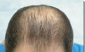 Hair restoration procedure results