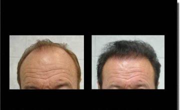 Hair restoration procedure results