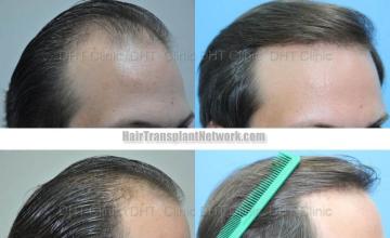  before and after photos