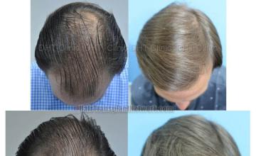 Hair transplantation surgery before and after images