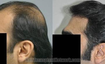 Hair restoration procedure before and after pictures