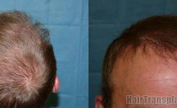 Closeup and back view of hair transplant results