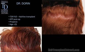 Hair transplantation surgery before and after pictures