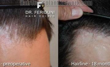 Hair transplantation surgery before and after photos