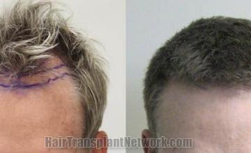 Hair restoration procedure before and after results