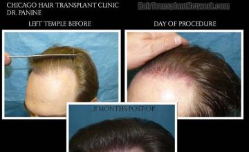 Hair restoration procedure before and after pictures