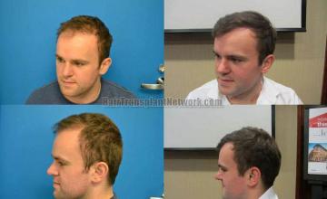 Hair transplantation surgery before and after photos