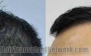 Hair restoration procedure before and after pictures