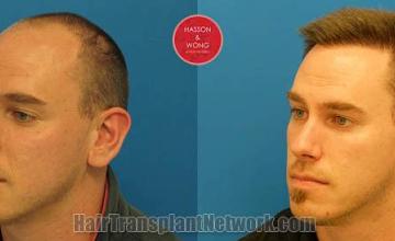 Hair transplantation surgery before and after pictures