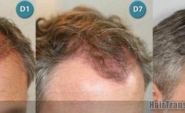 Right photos showing hair replacement surgery photos