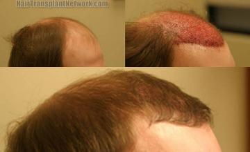 Hair restoration procedure before and after results