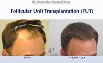 Hair transplantation surgery before and after images