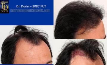 Hair transplantation surgery before and after images