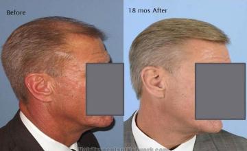 Hair transplantation surgery before and 18 months after images