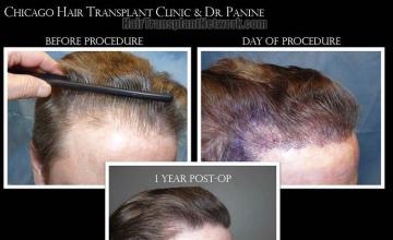 Hair transplantation surgery before and after images