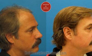 Hair transplantation surgery before and after images