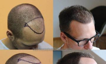 Hair transplantation surgery before and after images